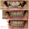 【調整日１９、２０回目】下の隙間をうめるためパワーチェーンでひっぱってます