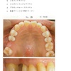 115回歯科医師国家試験【115B-62】歯間補綴学　咬合のズレ編