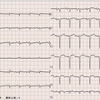 ECG-143：51才女性。呼吸苦と著名な浮腫でER搬入。