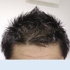 【2020/10/23】育毛 レポート  ミノタブ 1日1回でも 効果 あり!