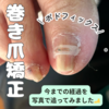 巻き爪矯正ポドフィックス／今までの経過を写真でわかりやすくしました！