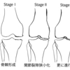 変形性膝関節症