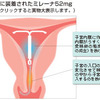 女体を引き受けることにした（５）ミレーナが抜けなくなったので静脈麻酔が必要になった