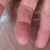 ちょっとした火傷に対処する