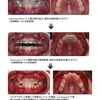 治療報告【叢生（八重歯）に対しての早期治療】