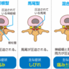 腰椎椎間板ヘルニアと脊柱管狭窄症の鑑別