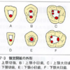 根管処置のゴール