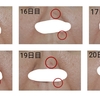 ほくろ除去　３週目の様子