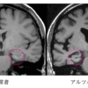 「第三の糖尿病」と言われる認知症を予防する方法！