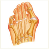 All The Things You Need To Find Out About Bunions