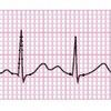 心電図　心房期外収縮（PAC）と心室期外収縮（PVC）