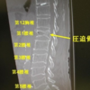 脊椎圧迫骨折への対応