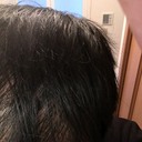 若ハゲと肌の凸凹を治療する