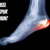 What Are The Main Causes Of Inferior Calcaneal Spur