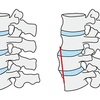 腰痛の原因となる「腰椎すべり症」について整形外科医が解説してみました 