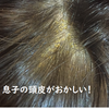 息子の頭皮の一部分に脂漏性皮膚炎の症状が出た