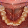 12歳臼歯の水平埋伏