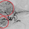 肝臓癌の化学塞栓術 ビーズTACE【No.5】肝臓がんの治療例
