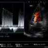心エコー。大動脈弁逆流の重症度評価にはどの評価方法を使ってますか？？大動脈弁閉鎖不全。
