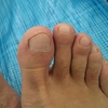 湘南国際リレーマラソン 足指の変化（微グロ注意）