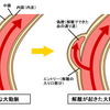 健康編　大動脈解離