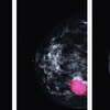 Breast Imaging Technologies Market Development, Growth and Forecast to 2020