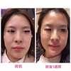 オトガイ形成による顔貌の変化