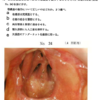 118回歯科医師国家試験【118A-76】義歯：顎義歯