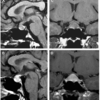 症例95：分娩翌日から頭痛を発症した40歳女性（Am J Emerg Med. 2021 Jan;39:258.e5-258.e6.）