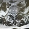 MRI 再収束パルス(リフォーカシング)