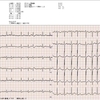 ECG-192：80才代男性。心電図自動診断で、心房細動でした。