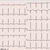 【コラム-029】Brugada型心電図に出会ってしまったら。。