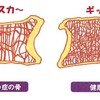 圧迫骨折を引き起こす骨粗鬆症の治療方法は？