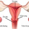 Trả lời một vài thắc mắc về bệnh viêm lộ tuyến cổ tử cung