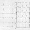 ECG-136：59才男性。強烈な胸部不快間と冷汗でERヘ。