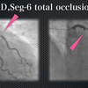 ECG-098：answer