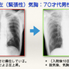 【コラム-070：左気胸の心電図を、ちょっと考えてみます。(1/2)】