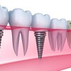 Chi phí cấy ghép răng implant có giá bao nhiêu ?
