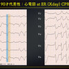 ECG-342：answer