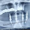 Implantologist Treatment in Kumbakonam - Banu Multispeciality Dental Clinic