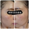【低周波ペンシルでシミを取ってみた！⑩】照射5回目～もうあまり目立つシミはないのでソバカスになりづらい？【経過写真有/シミ取りビフォーアフター】