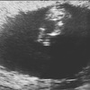【妊娠】第三子、妊娠10週〜11週