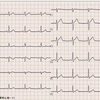 【コラム-020】正常心電図04＝(18誘導+1)：47才男性。