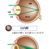 白内障手術後に急増！？現代病[加齢性黄斑変性]