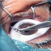 Understanding There Are Lasik Eye Surgery Side  Impacts