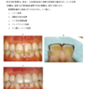 113回　歯冠補綴学振り返り　ラミネートベニア編