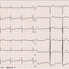 ECG-182：90才代女性。AS/LVHあります。