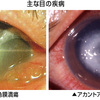 (現役医学部生が教える)コンタクトを正しく使ってないとそんな病気に？！