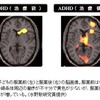 ＡＤＨＤ患者の脳の働き解明　神戸の理研など