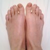 Mortons Neuroma An Overview